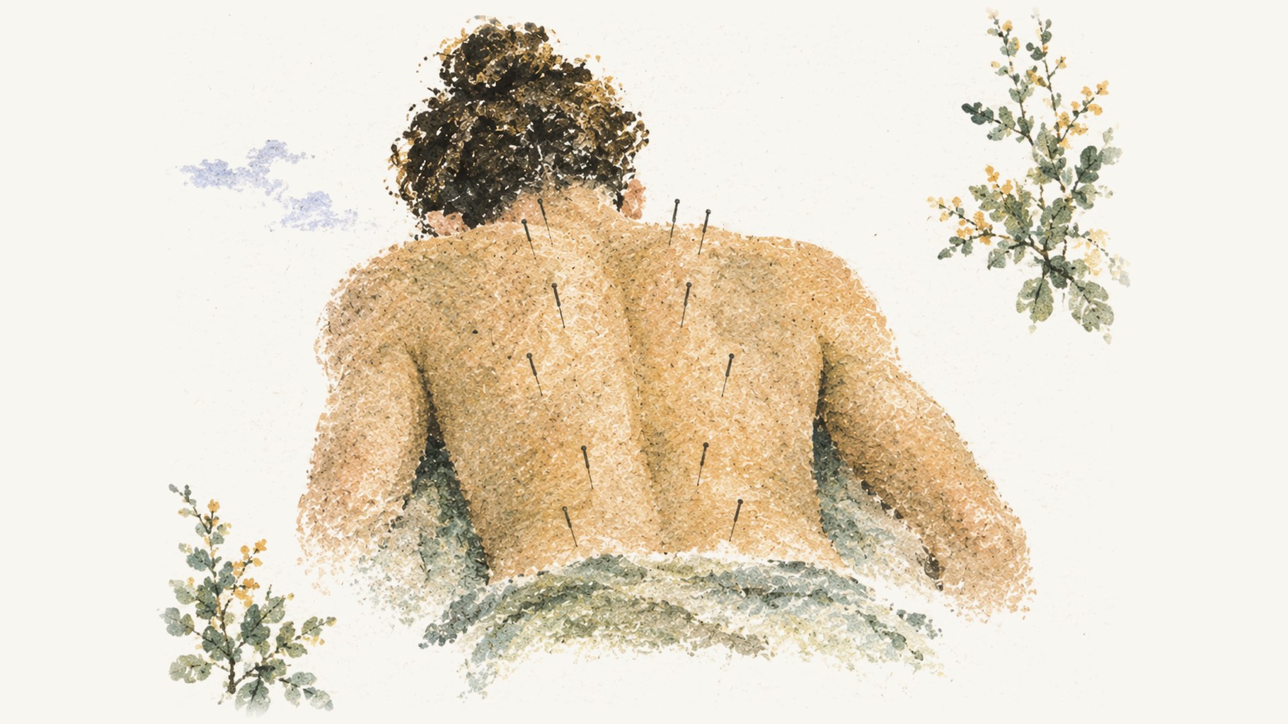 Fine acupuncture needles placed along a patient's back during a session.